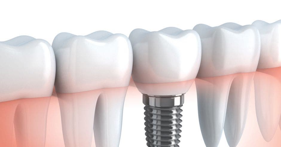 Una serie de dientes e implantes dentales