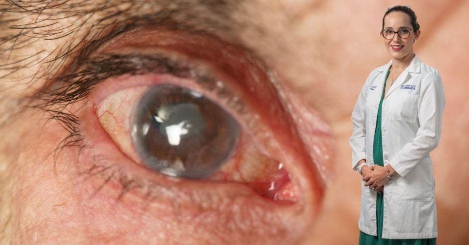 no menos 80 millones personas mundo víctimas glaucoma enfermedad progresiva daña nervio óptico afectando fibras nerviosas ojos generando daño irreparable puede llevar mayoría casos pérdida visión explica Dra. Karla Van Dick, oftalmóloga hospital Clínica Bíblica